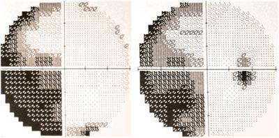 Visual Dysfunction in Posterior Cortical Atrophy